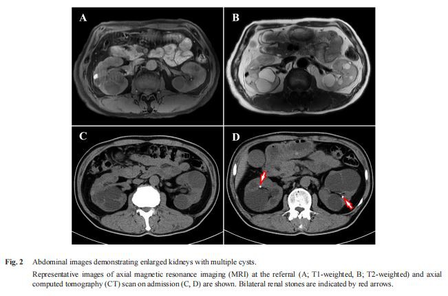 Abdominal images demonstrating enlarged kidneys with multiple cysts