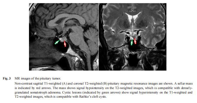 MR images of the pituitary tumor.